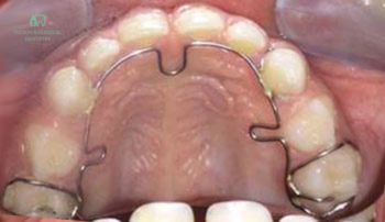 alf treatment case 1 image 1