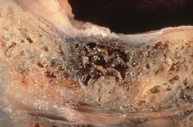 Image of Dental Cavitations