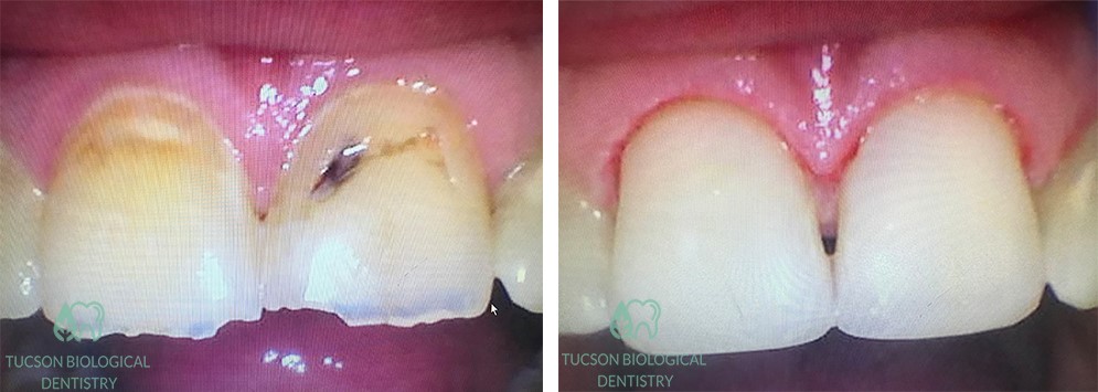 alf treatment case 1 image 2