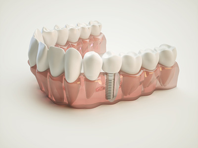 Dental Implant Restorations in Tucson AZ area