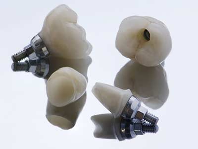 Dental Implants Treatment in Tucson AZ area