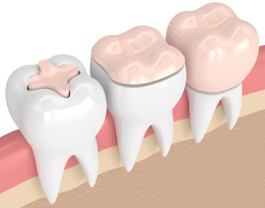 Biomimetic dentistry services from dentist in Tucson, AZ, conservation of tooth structure doing onlay and inlays vs full crown