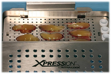L-PRF Therapy Tucson -Leukocyte-Platelet Rich Fibrin Latest Technology