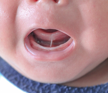 Frenectomy for tongue and lip ties Tucson, AZ